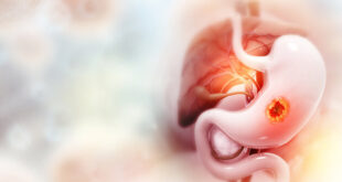 Ulcer