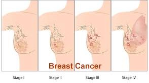 Breast Cancer Alert