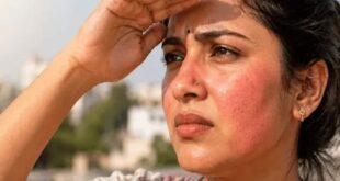 धूप में निकलते ही लाल हो जाती है स्किन? यह मामूली टैनिंग नहीं, हो सकती है PMLE एलर्जी, जानें इसके लक्षण और बचाव